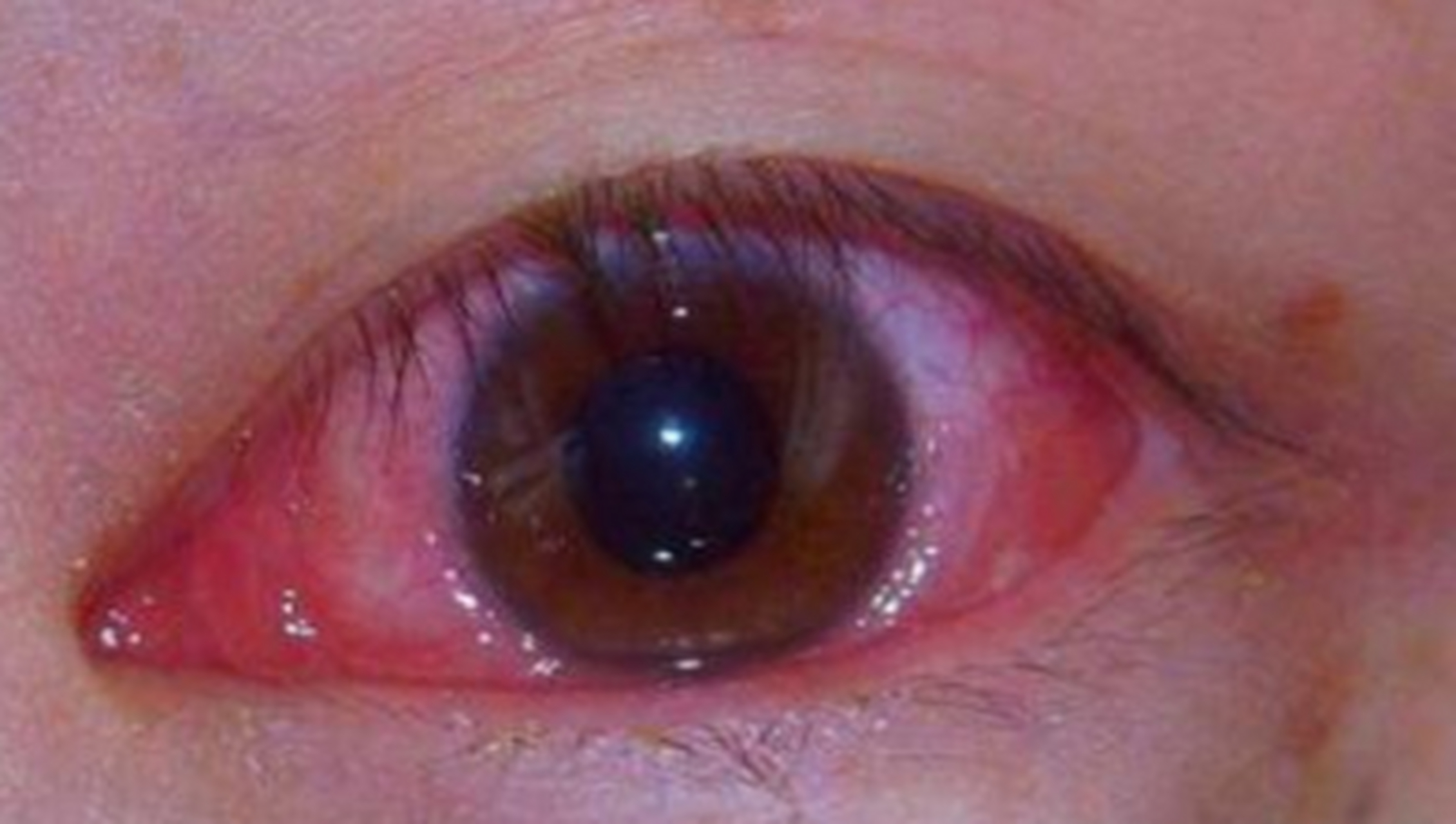 16 有结膜炎症状,大家多多关注!