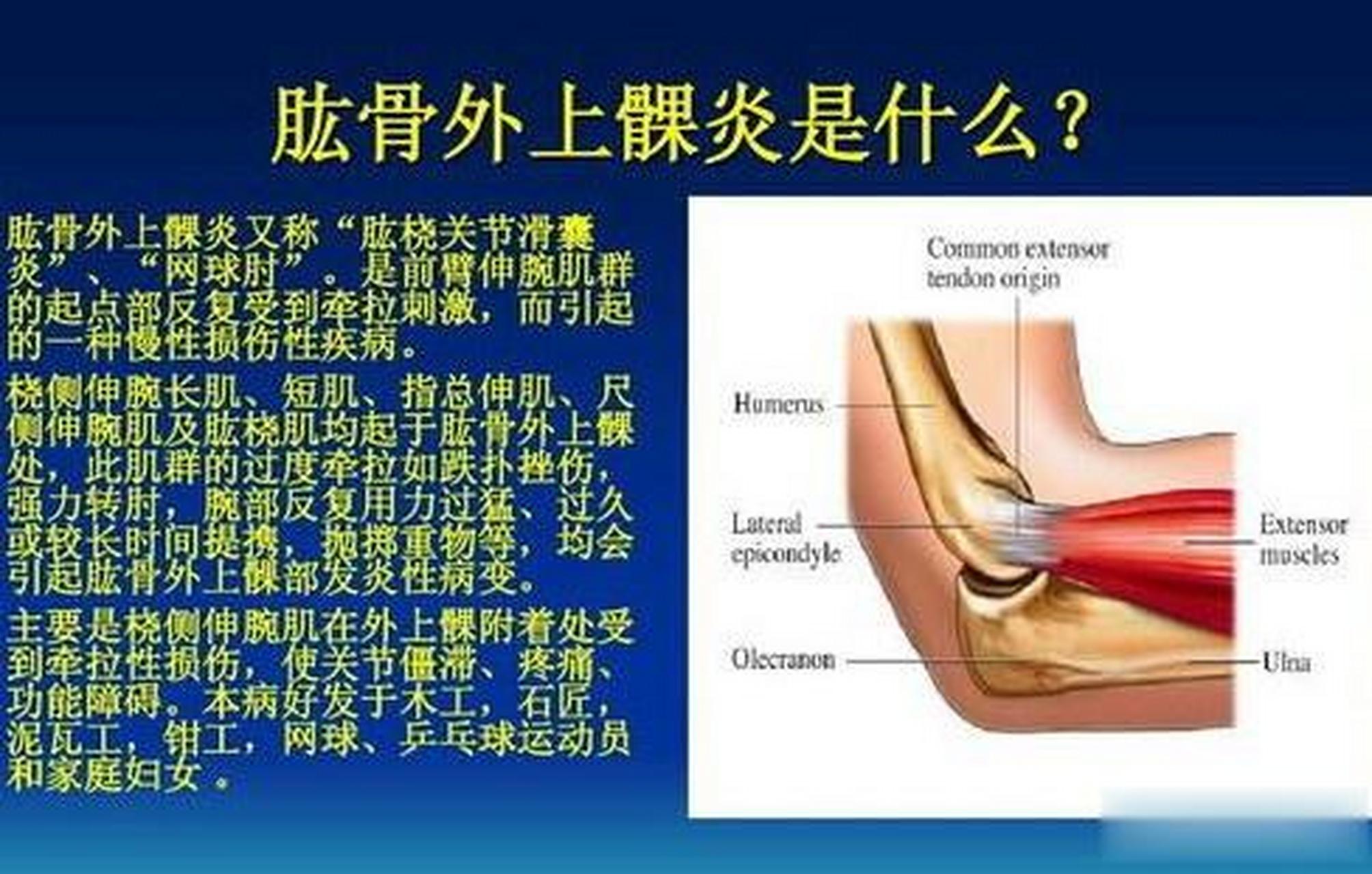 肱骨外上髁炎,俗称"网球肘",又称桡侧伸腕肌腱劳损,又可称为肱骨外上