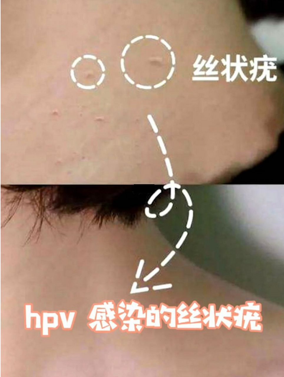 脖子上长褐色的小点点,这个方法简单有效  脖子上长了这些丝状的小