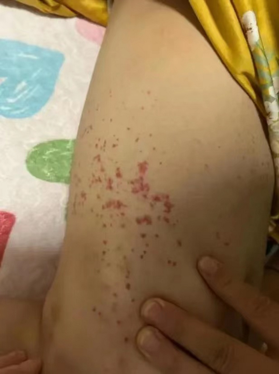 慢性特发性血小板减少性紫癜,一般出现于20-50 岁的成年人,女性为