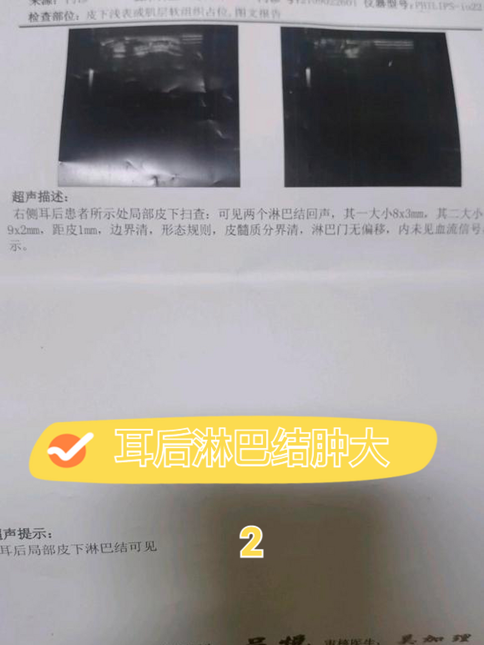 耳后淋巴结肿大 2  今天最后一次去血液科看了,这个血液科的大夫非常
