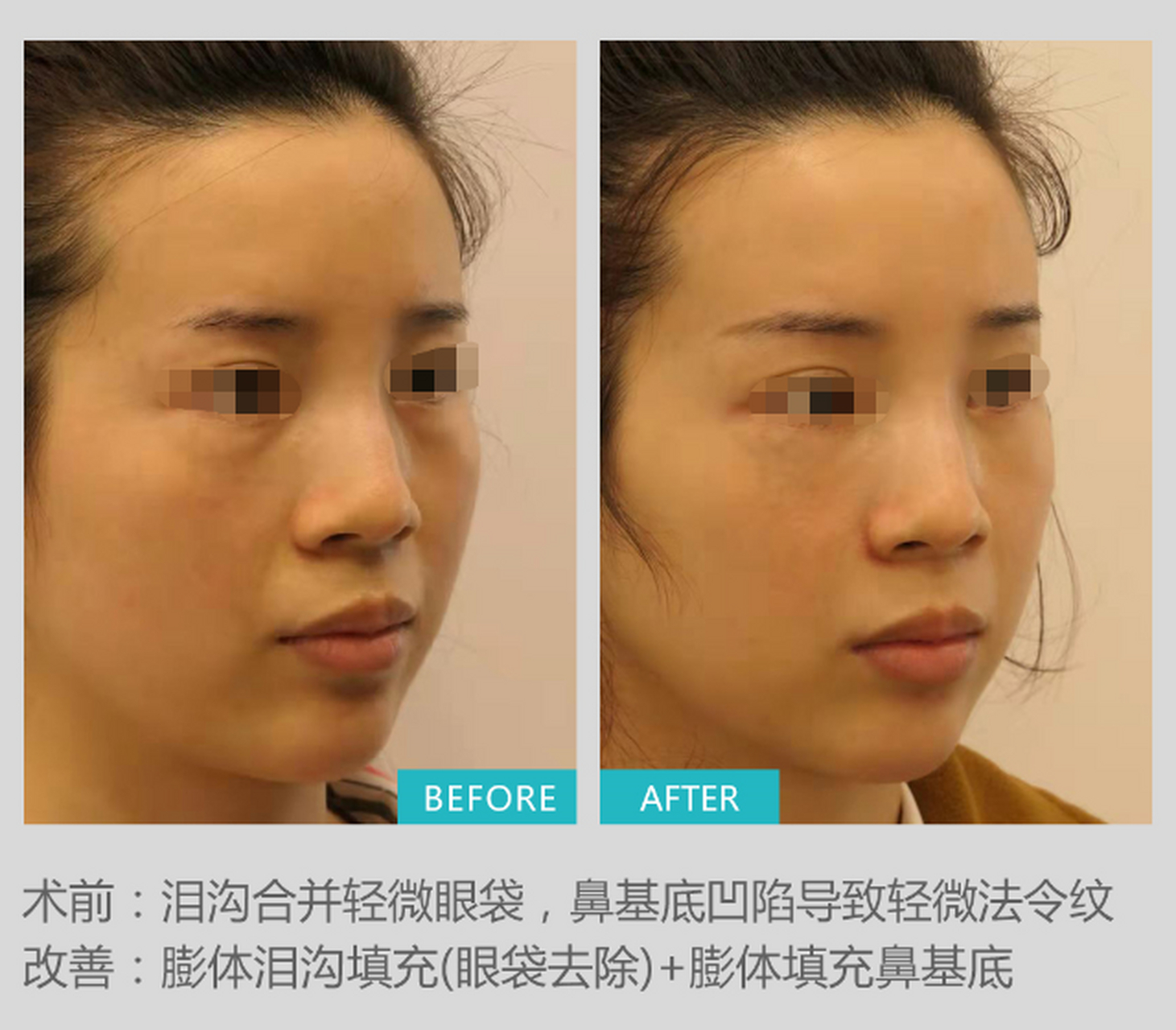 听说用膨体填充鼻基底后就不能正常笑了,是真的吗?