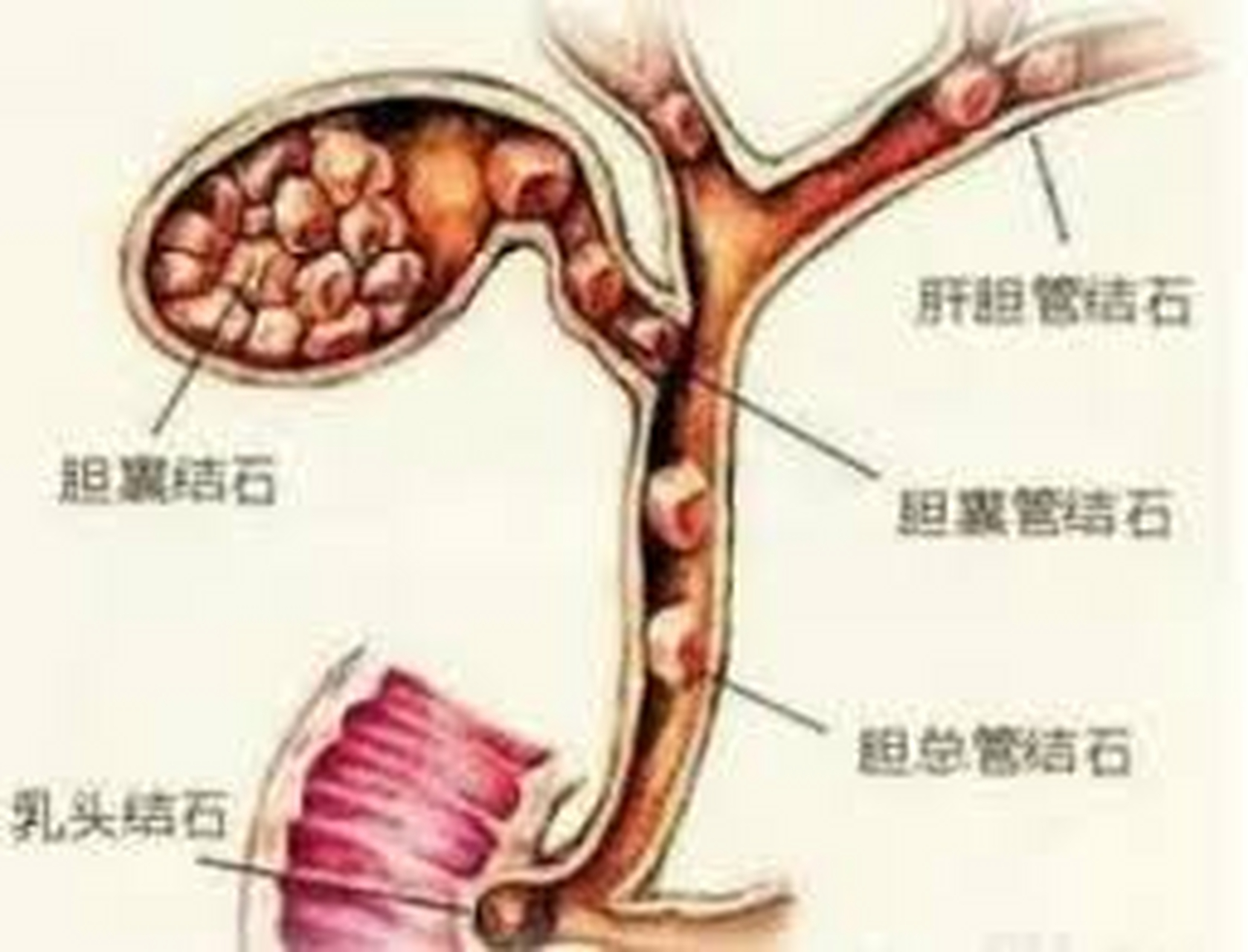 腹腔镜-胆道镜联合探查取石术,是一种微创手术方法