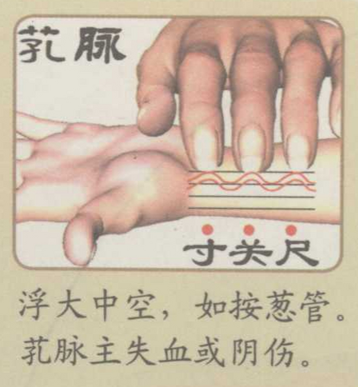 芤脉 轻取时脉管柔软中空,脉形大,像在按葱管.