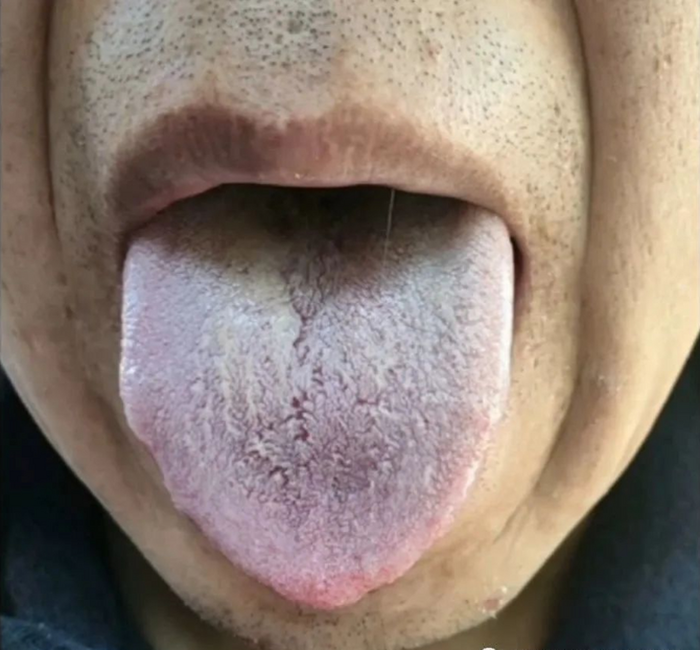 舌象分析——失眠,抑郁(水寒郁类型)  患者主诉睡眠不好,情绪抑郁.