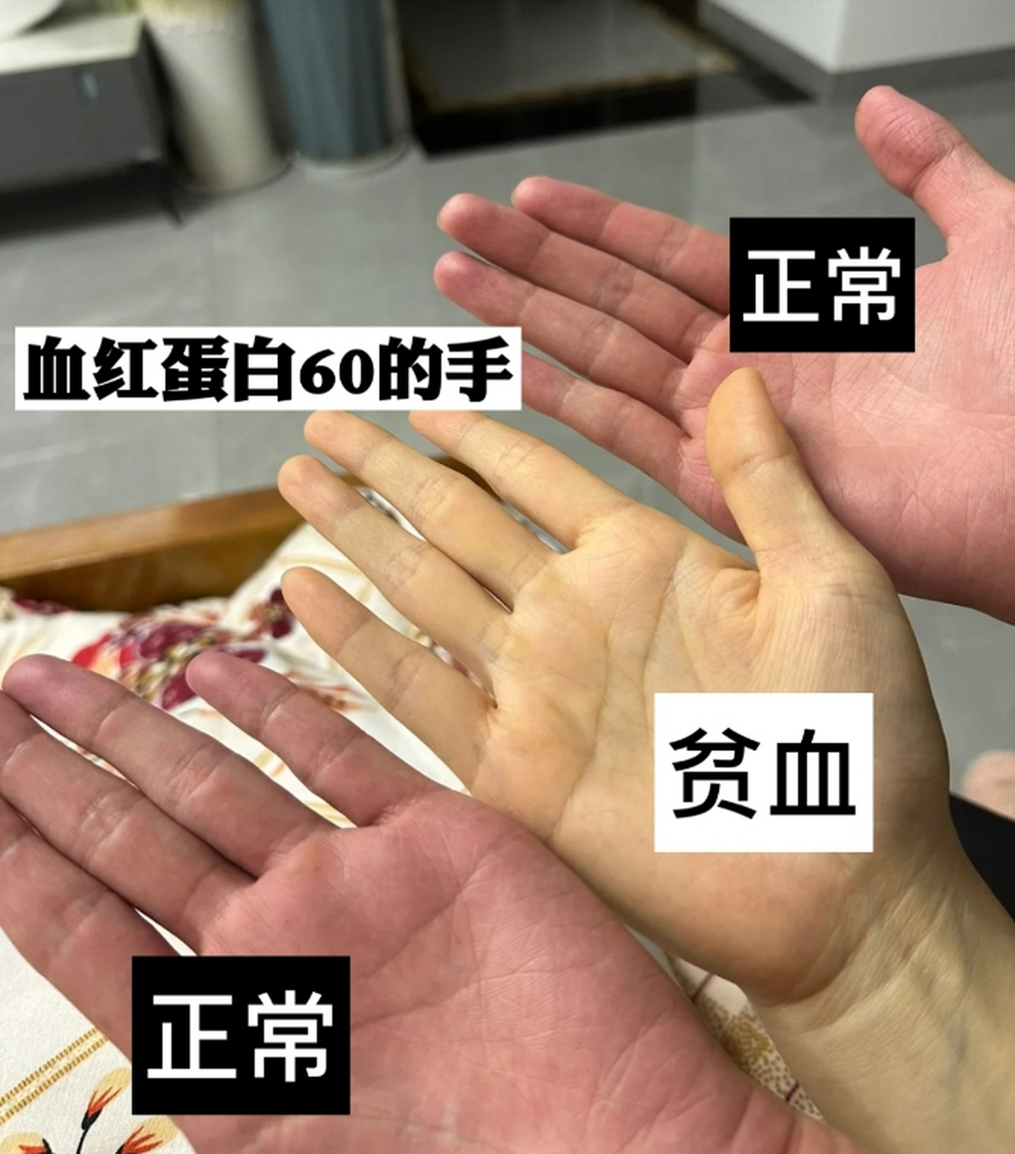 你是否有贫血的一些症状?