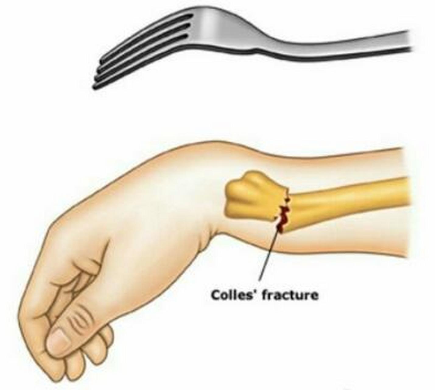 colles骨折通常发生在一只伸出的手上摔倒