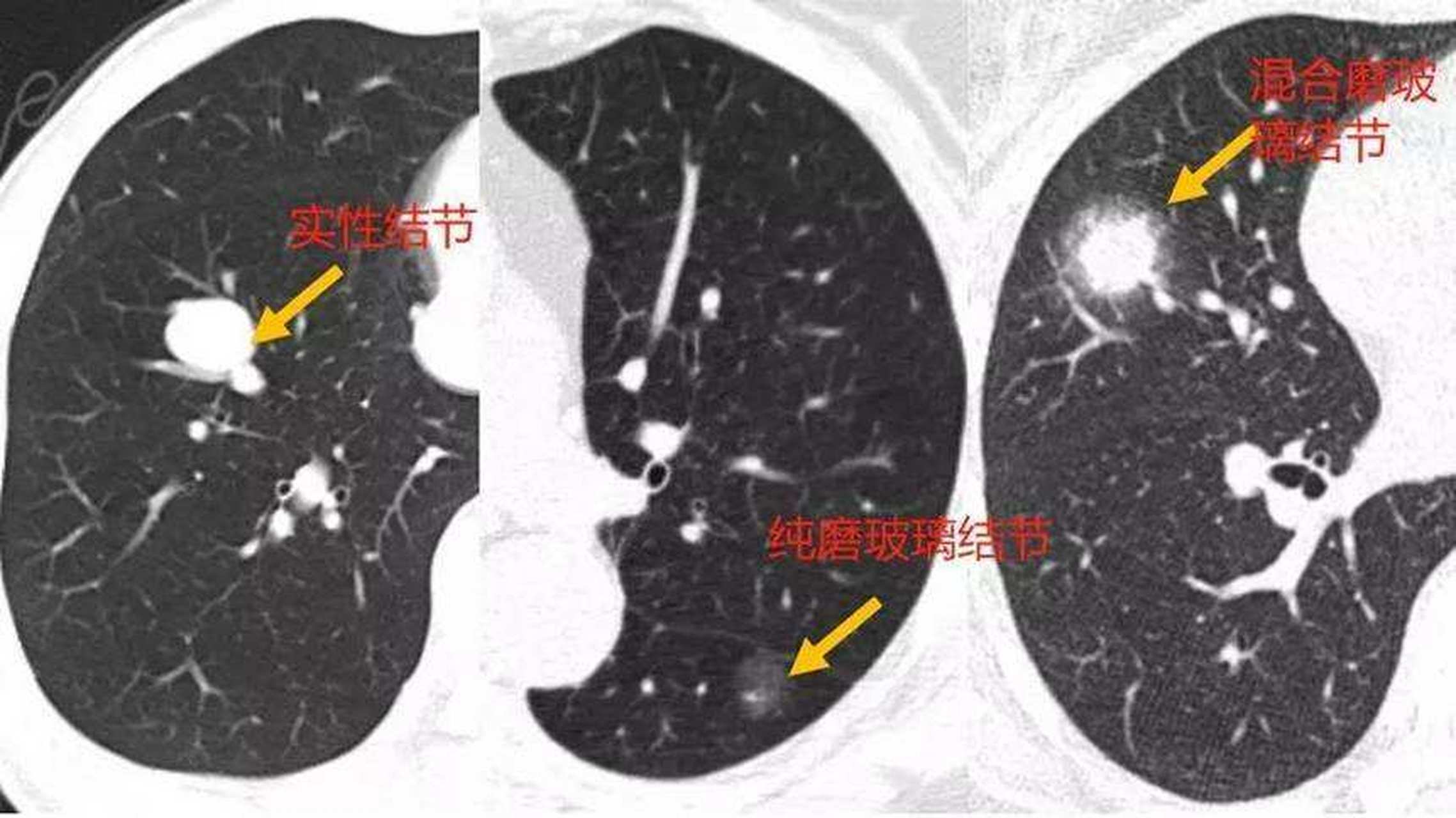 今年62岁的李先生,曾在5年前查出肺结节,是右肺上叶实性结节5mm,边缘