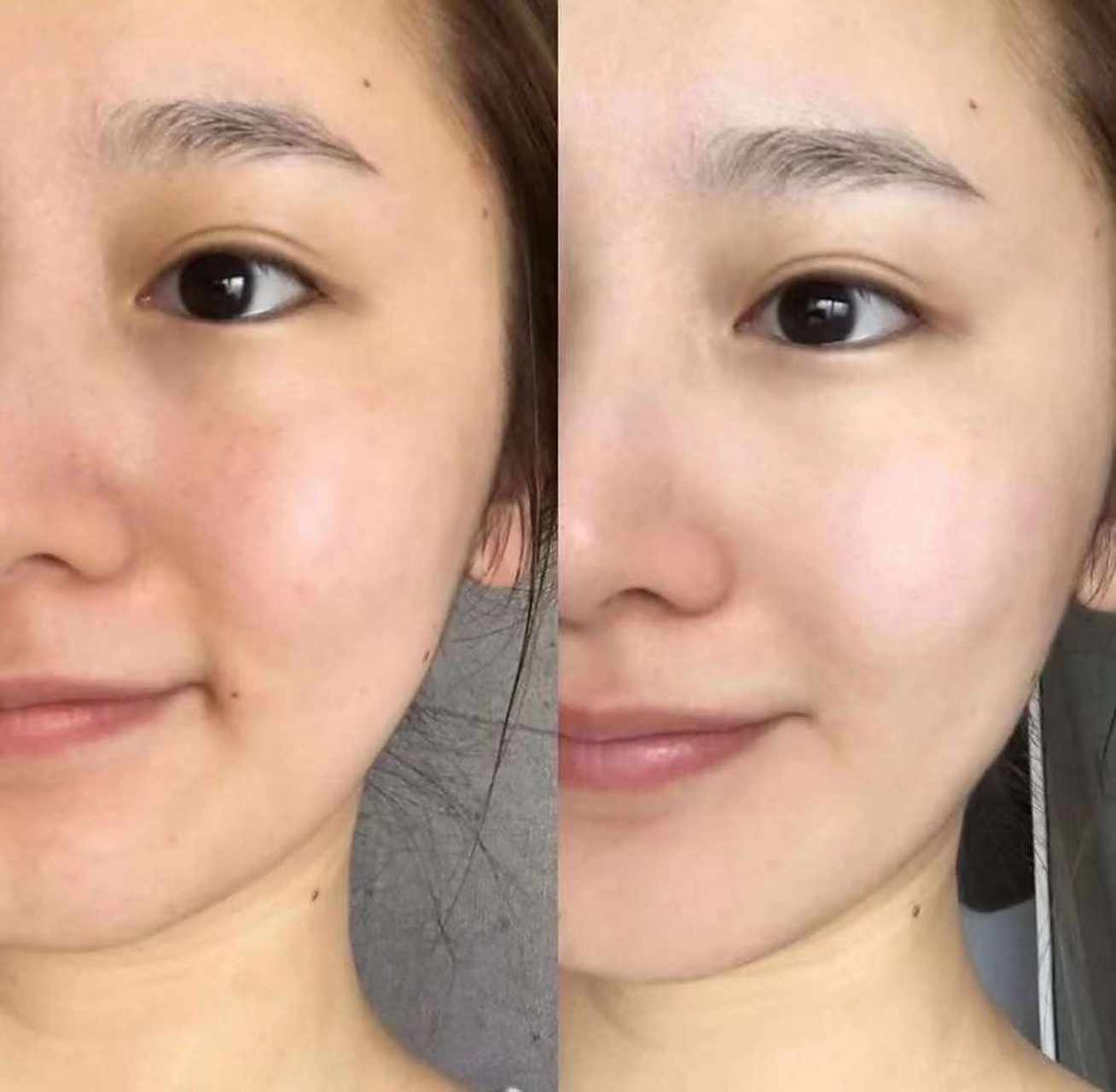 烟台曙光光子嫩肤#  m22黄金超光子嫩肤78 日常维护肌肤不可缺伞