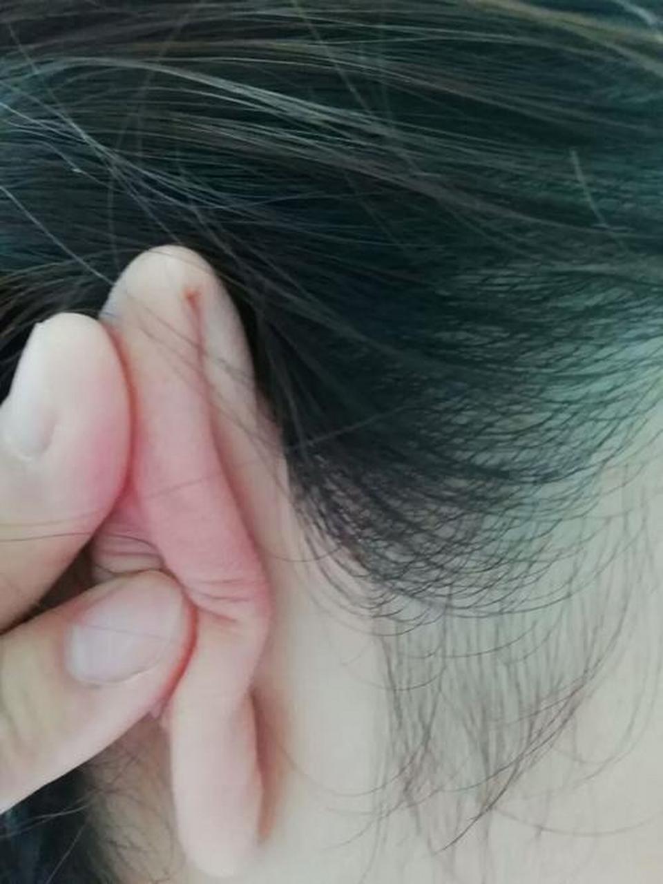 在我们的生活中,很多患者喜欢通过割耳朵放血的方式来治疗银屑病,它