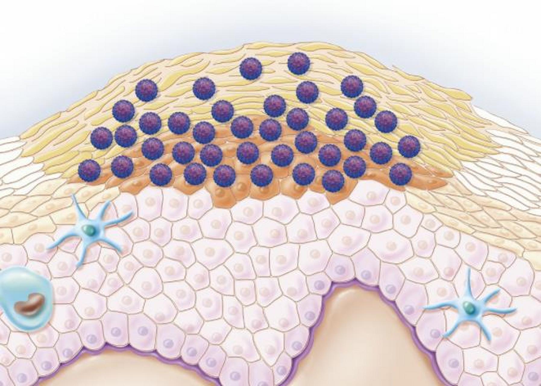 皮肤疣是由人乳头瘤病毒感染皮肤和黏膜上皮,所引起的良性增生性