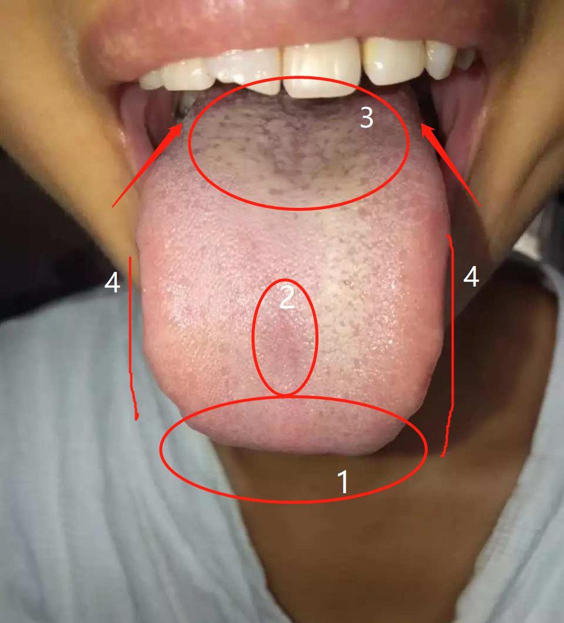 昨天遇到一位女士,肝郁气滞血瘀,下焦寒凉的情况,67舌头也是很典型