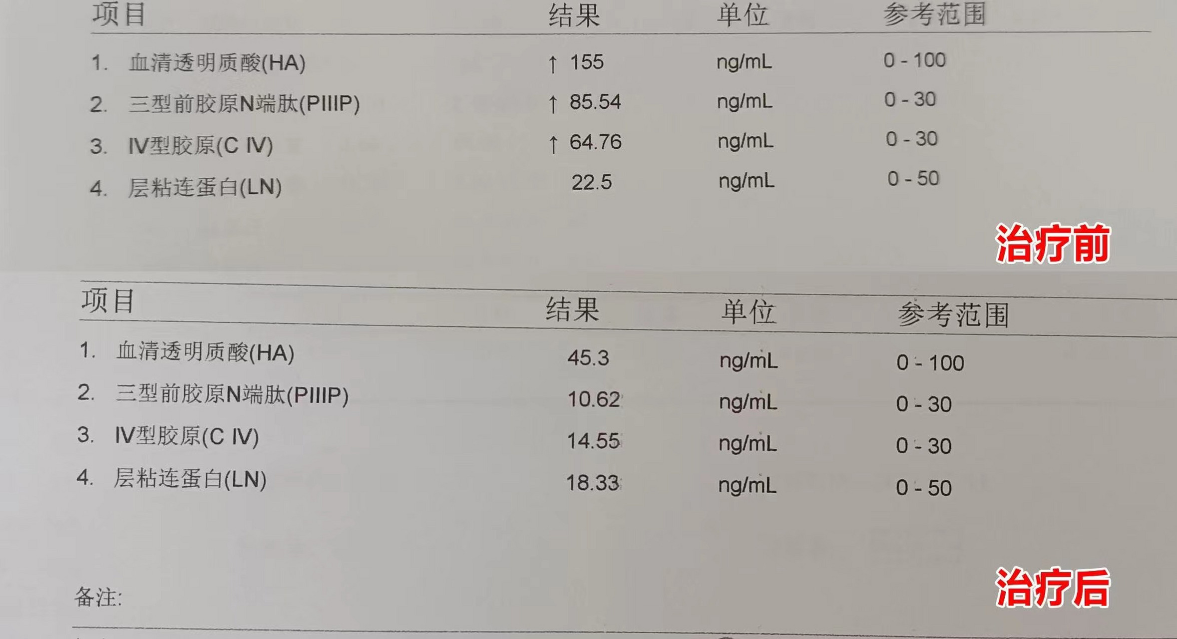 乙肝 乙肝患者初诊肝纤维化损伤,肝功能多项异常,经过双抗联合