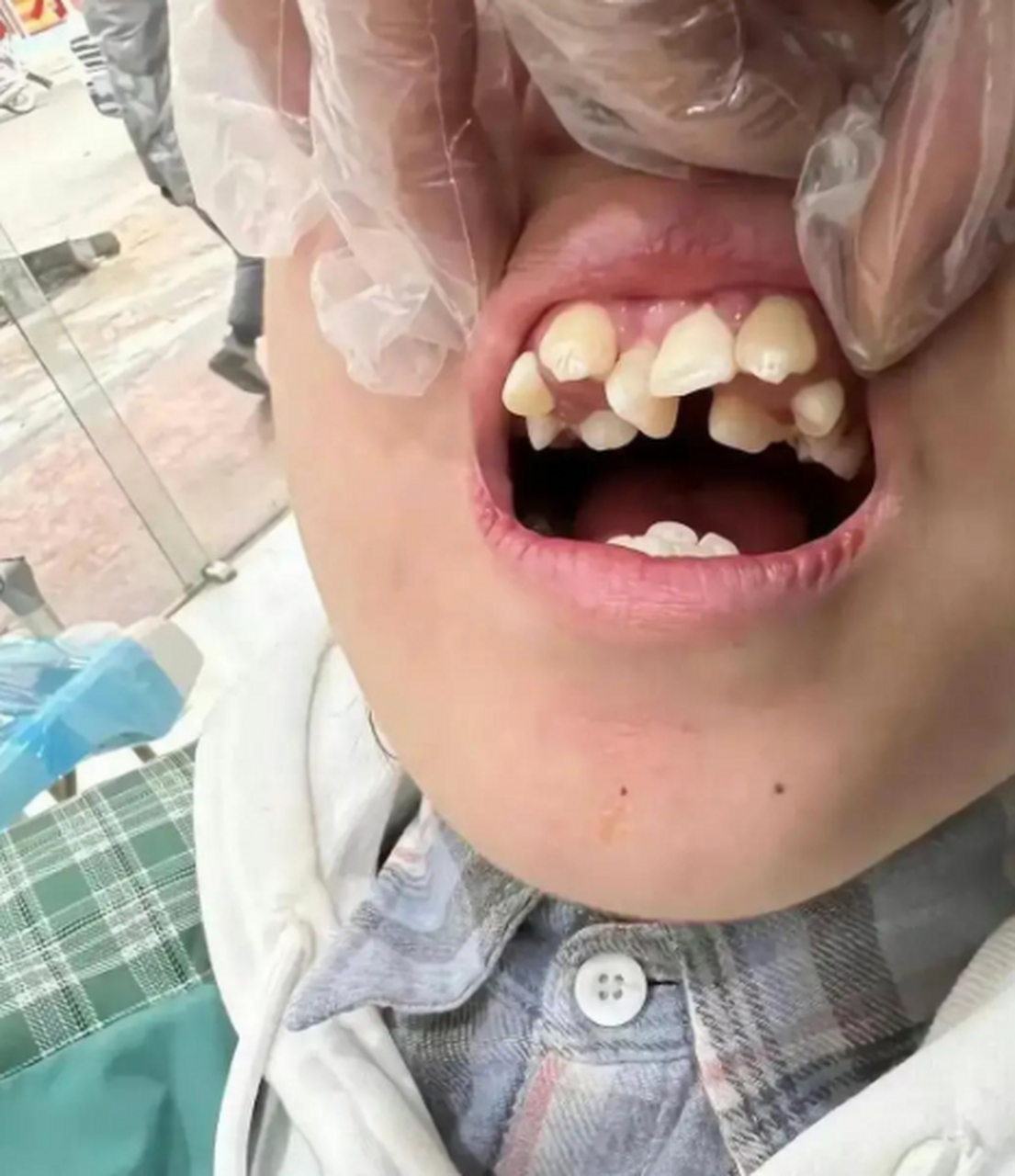 现在什么世道,连牙齿都在争先恐后的往外长,不知道排队了[捂脸]
