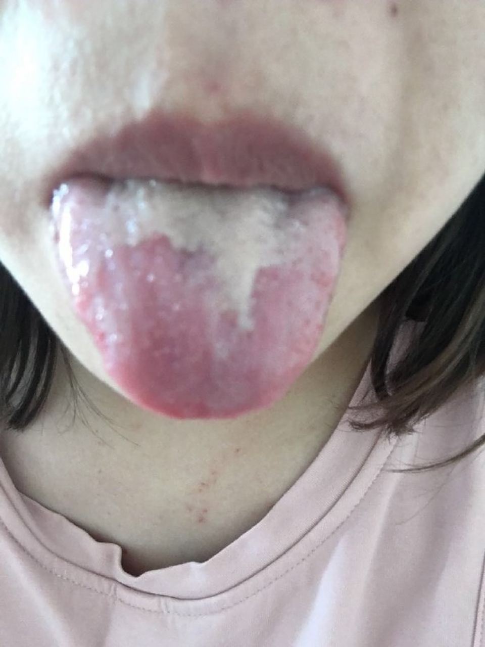 剥苔舌,地图舌,可不仅仅只有阴虚  这是一个溃结患者的舌苔,前两张是