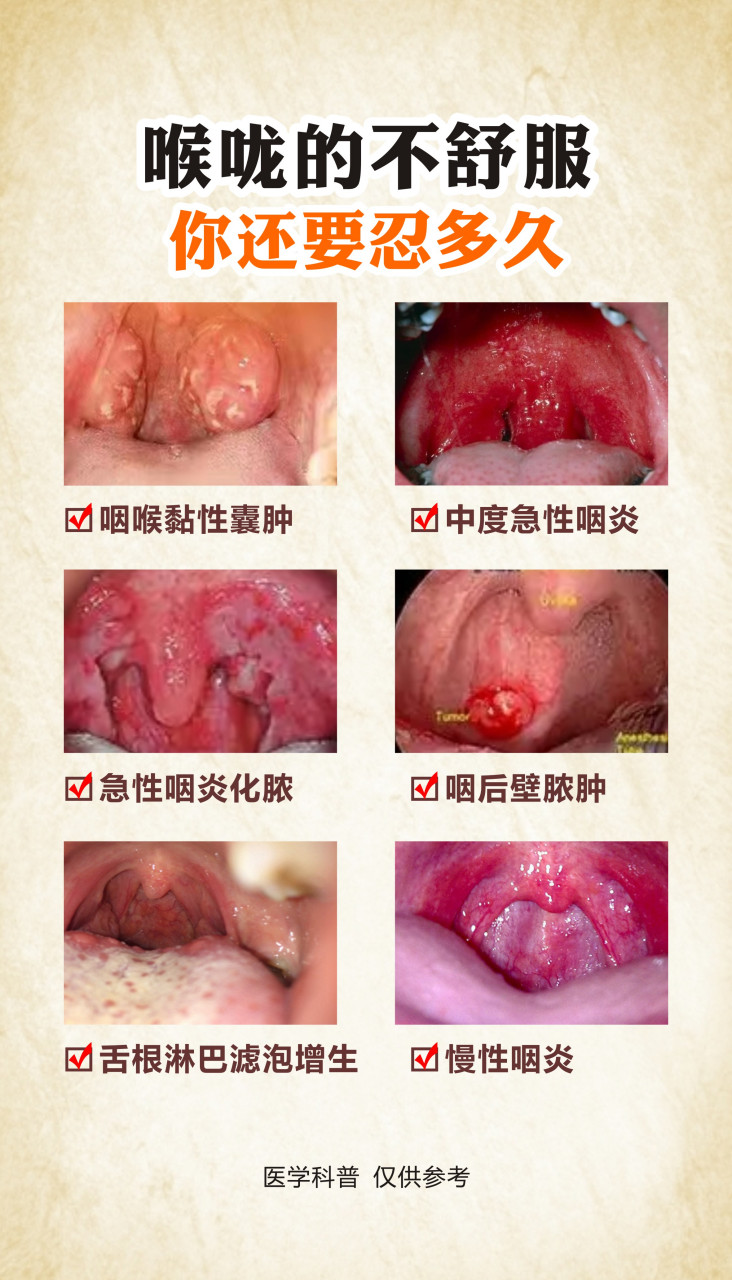 慢性咽炎的症状是比较多的,比如患者会经常出现咽喉部位有出现异物的