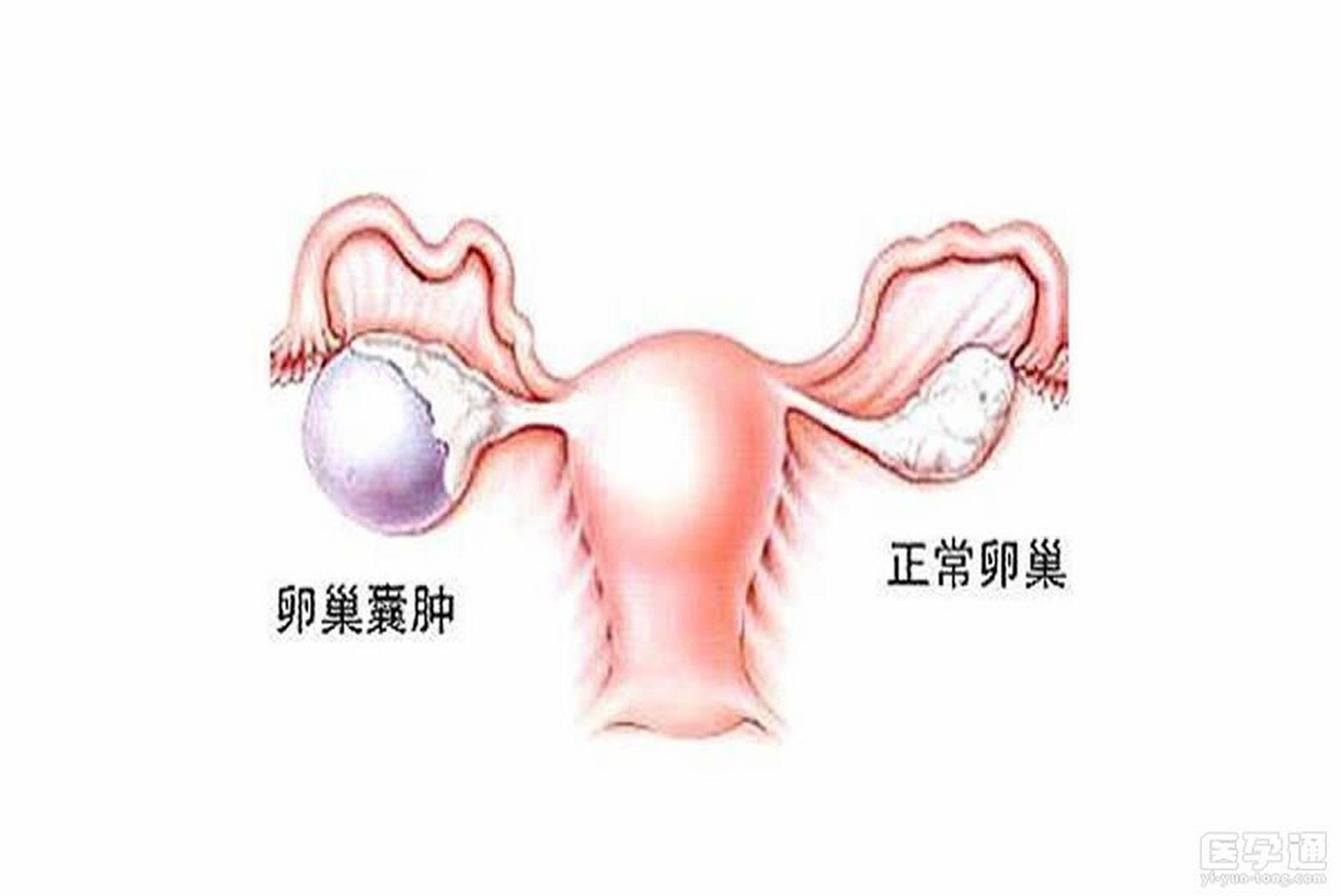 左边还是右边?卵巢囊肿一般哪里会痛?