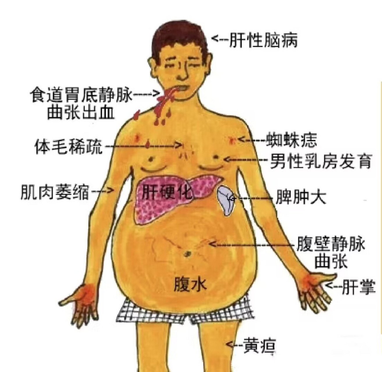 肝包膜图示图片