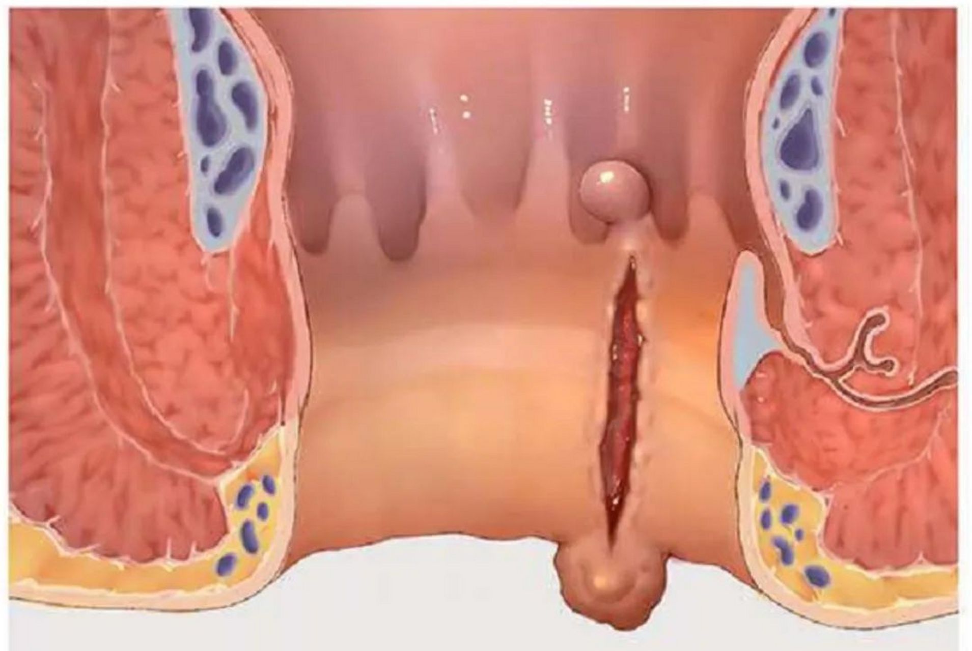 肛裂图片 清晰图片