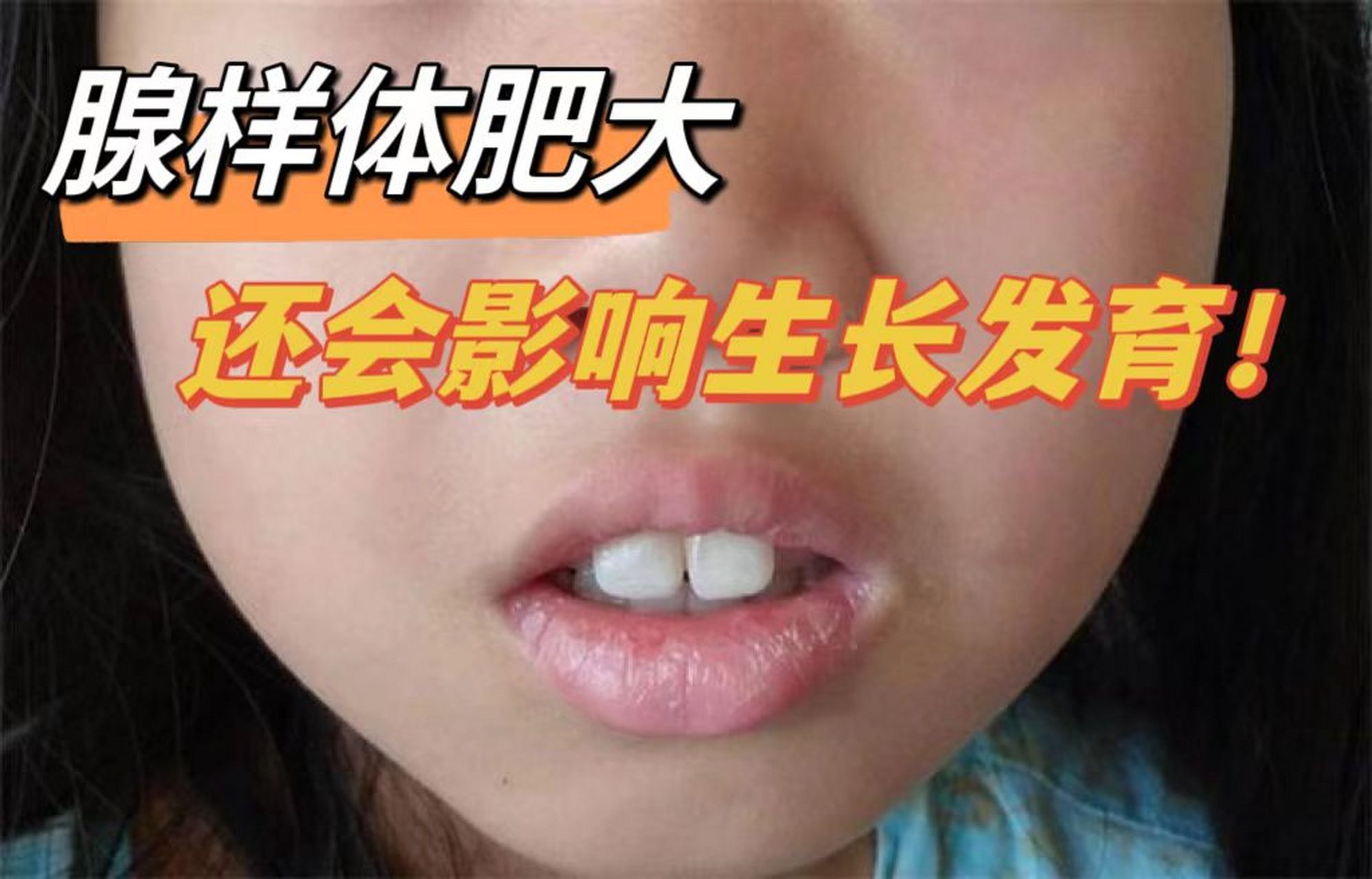 【腺样体肥大】睡觉打呼,张嘴,嘴巴变"突",孩子慢慢变"丑",手术后又