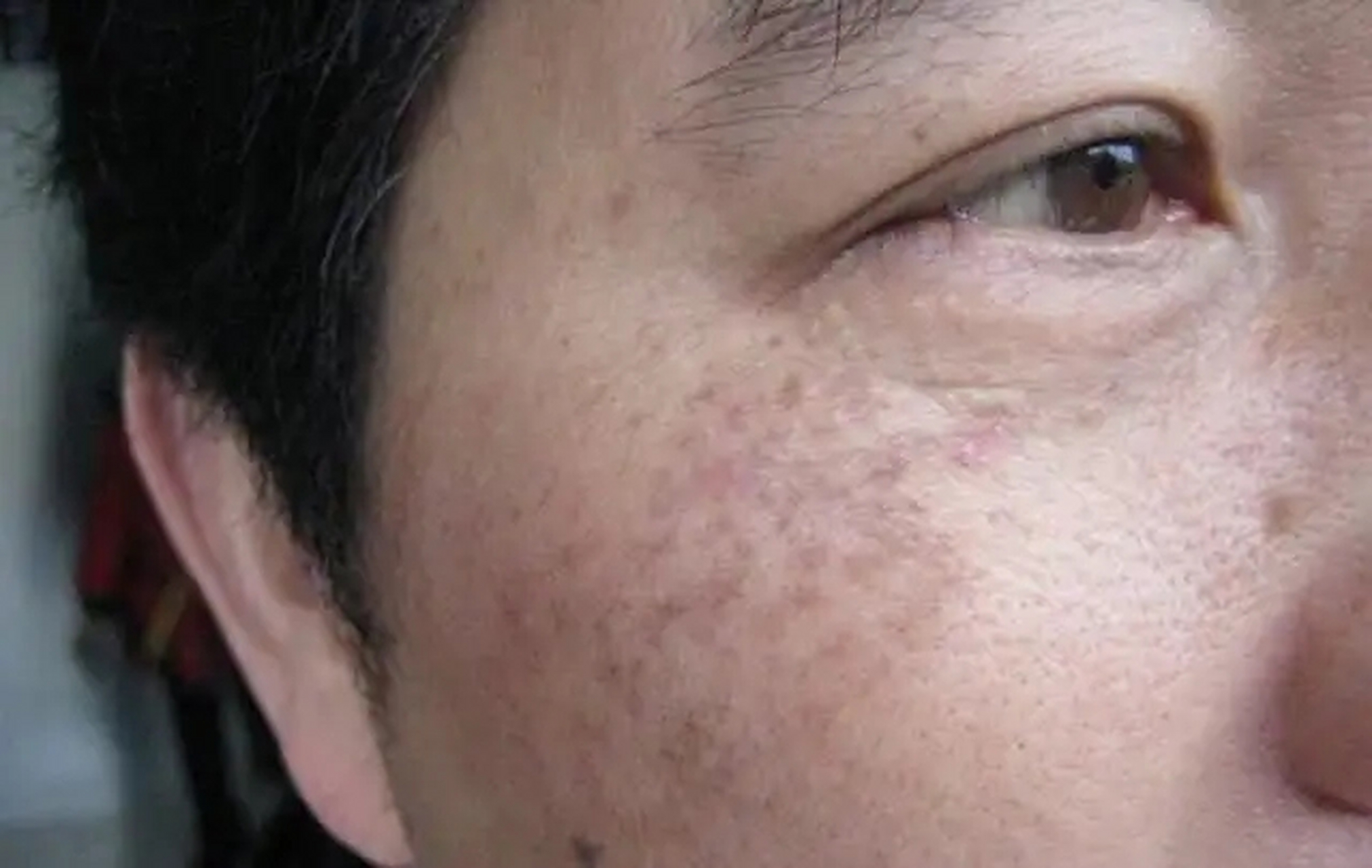 肝火旺,肝郁,面部4表现藏不住  1,黄褐斑 肝脏主