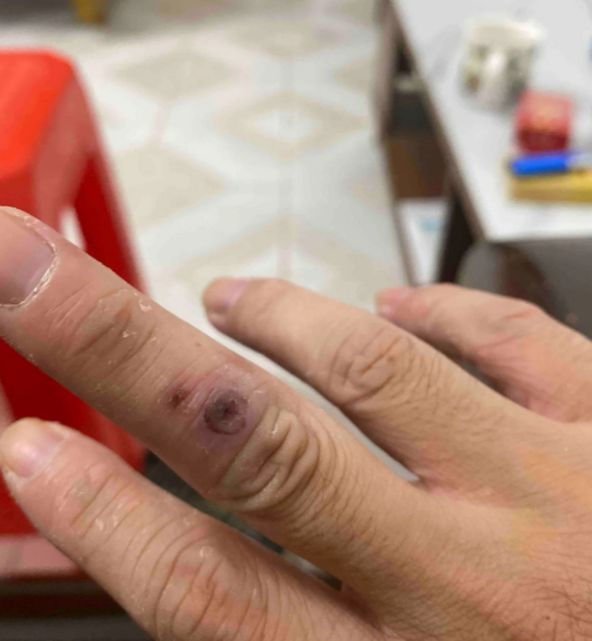 鱼鳞痣怎么去除 #医美科普挑战赛#  鱼鳞痣是一种常见的皮肤病,也被称