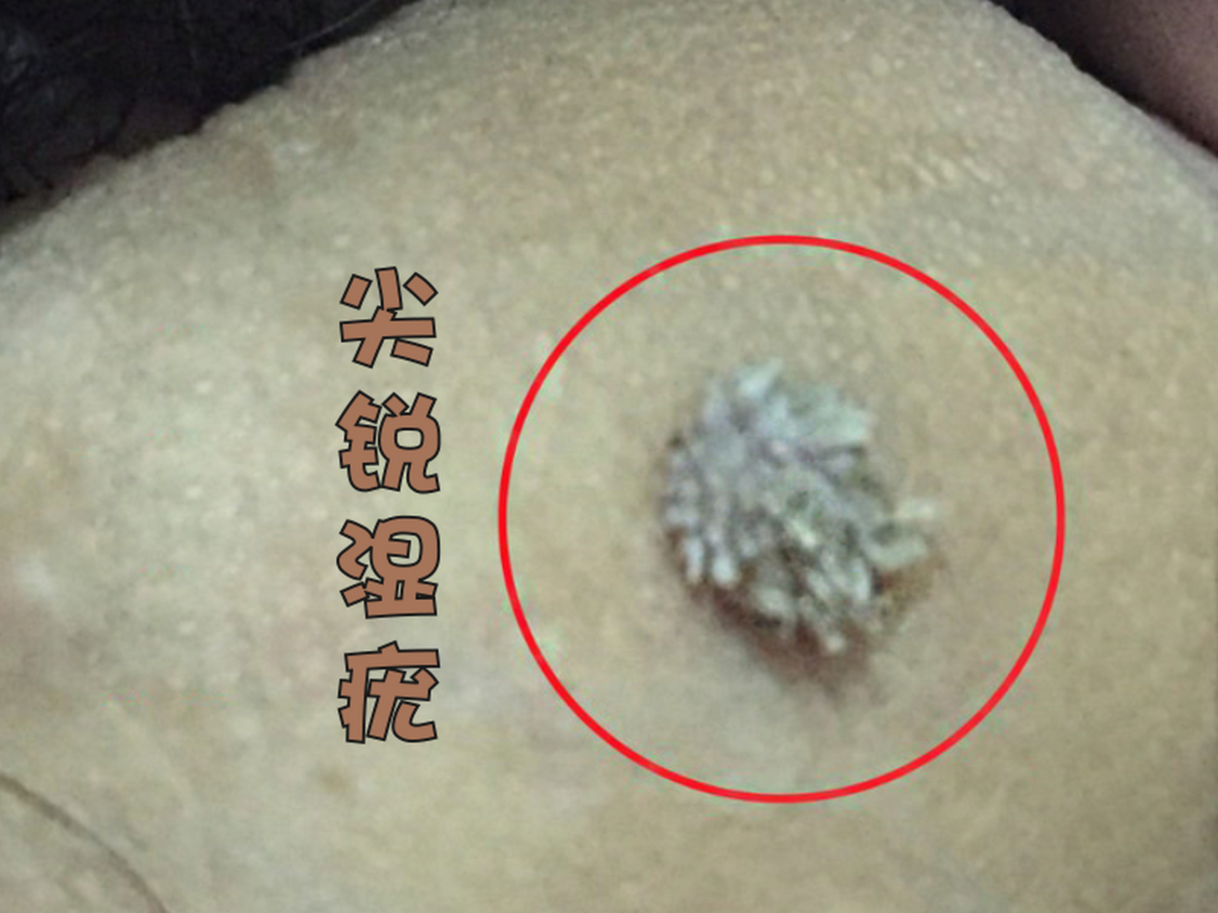 有一些小伙伴总是在自我焦虑:"尖锐湿疣会不会泛滥到全身?