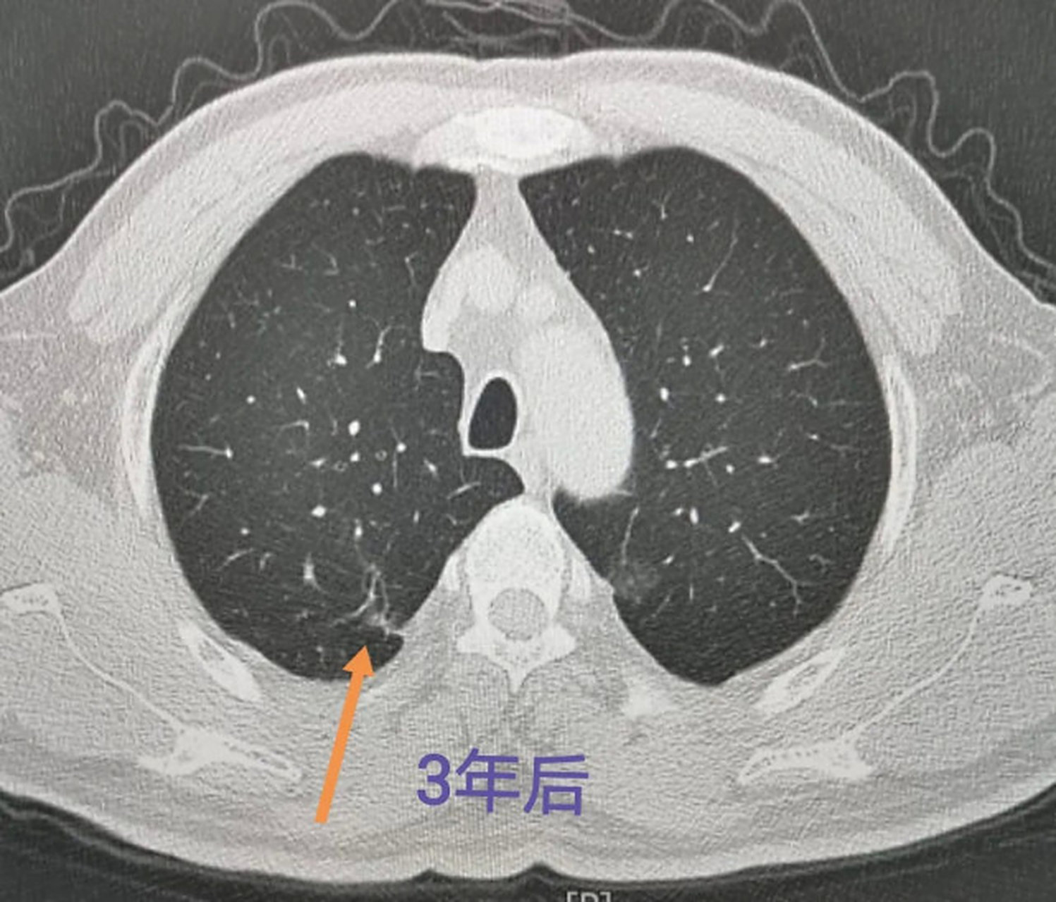 肺部结节钙化是个老生常谈的问题,95%以上的钙化结节属于良性.