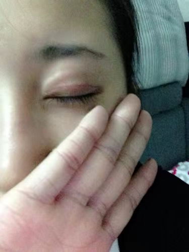 眼窝填充不建议(眼窝填充不建议做怎么办)