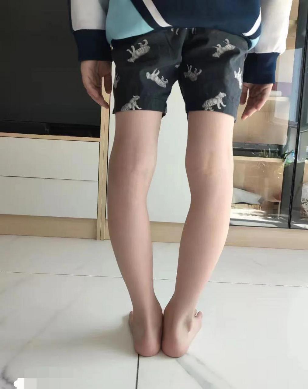 o型腿长成这样,连手术都困难了,而且还有足外翻,两者互相纠正,矫形