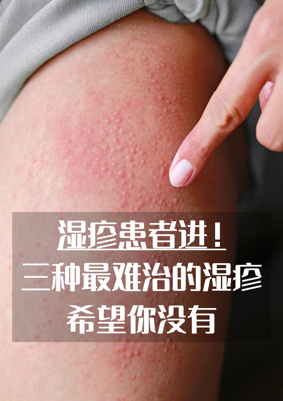 湿疹属于中医常见的皮肤病,主要可分为以下几种类型.