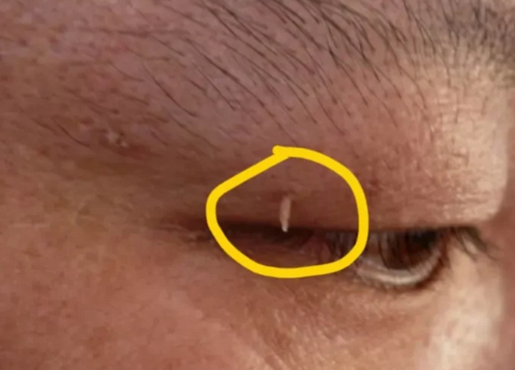 家里人说,是不是看到脏东西了 其实这叫丝状疣,是一种病毒感染引起