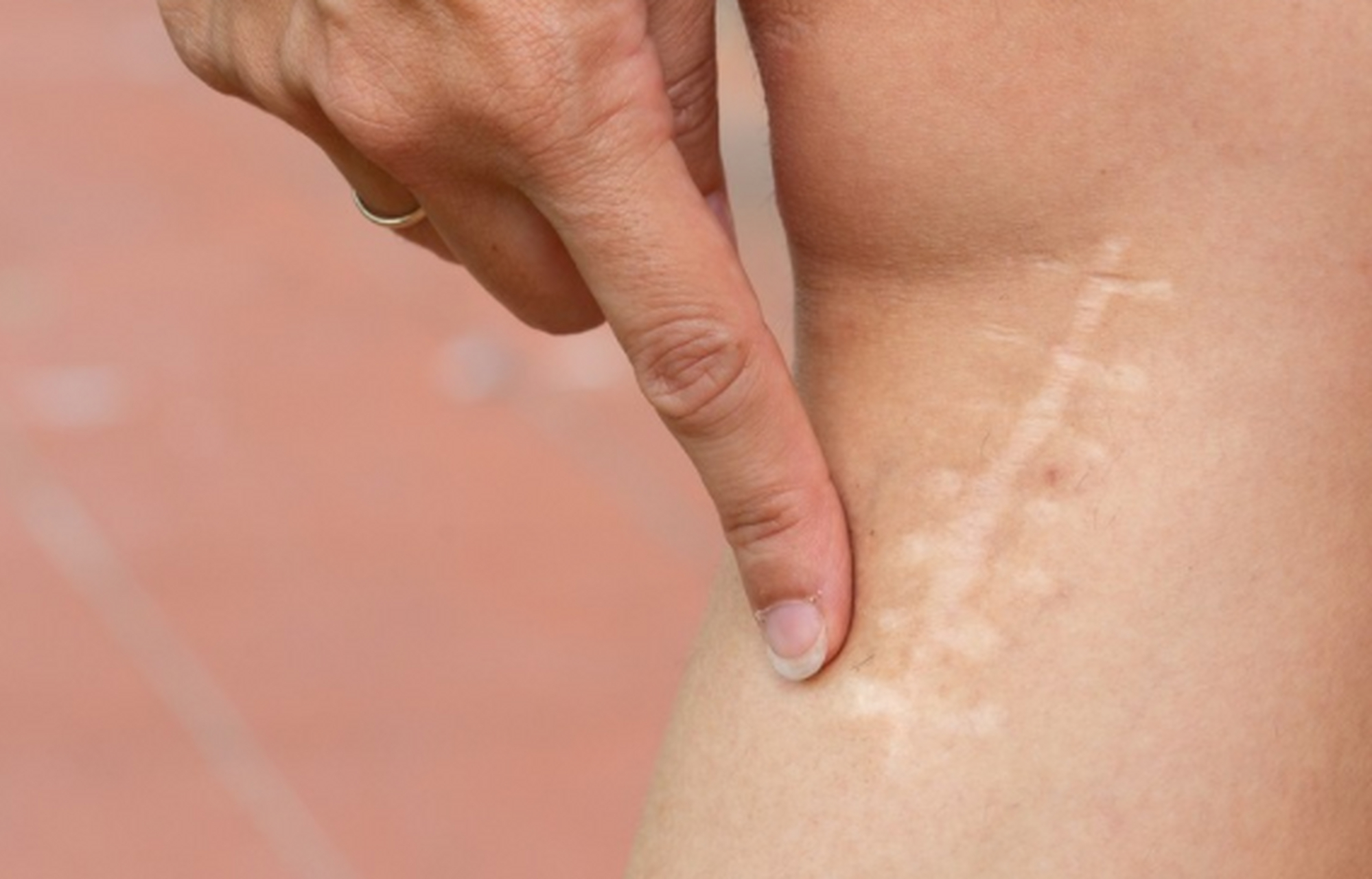 那么"蜈蚣疤"形成原因你了解吗,有以下几个方面大家可以了解一下.