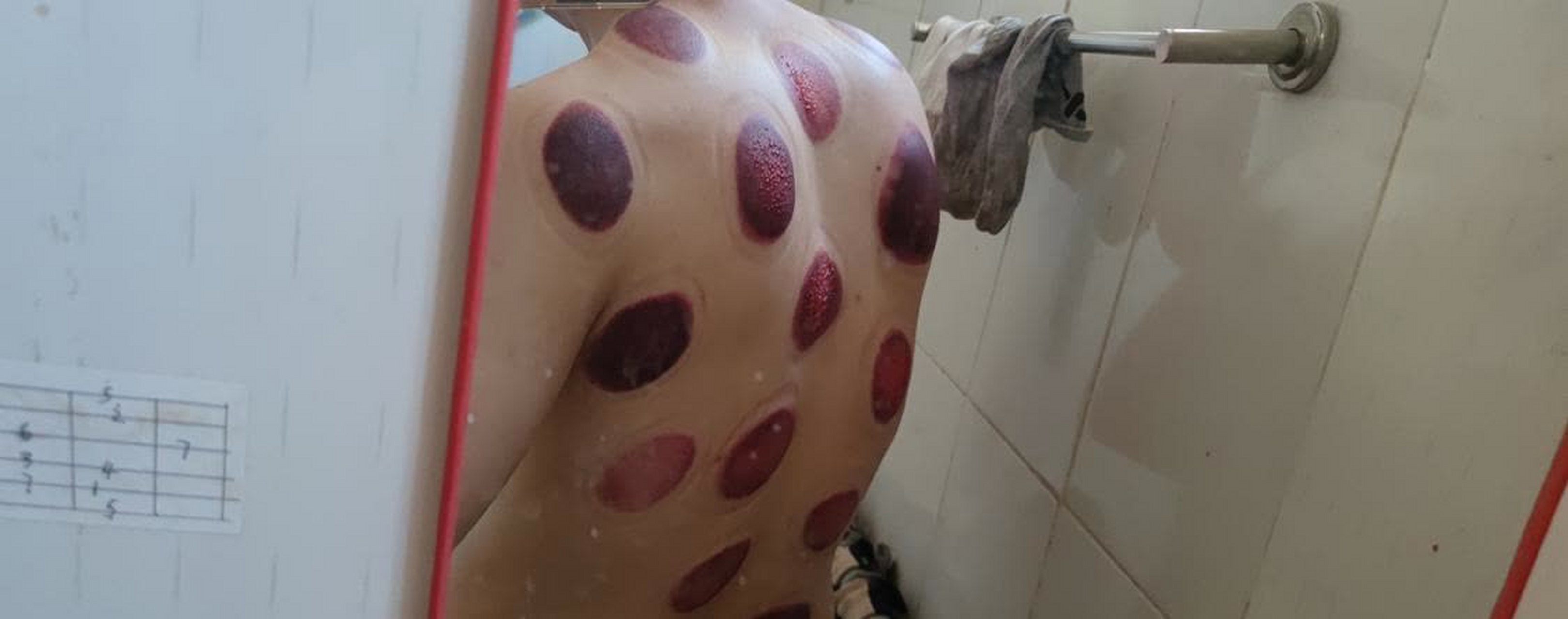 这是我第一次拔罐,拔出了很多水泡. 我一看到就害怕了.