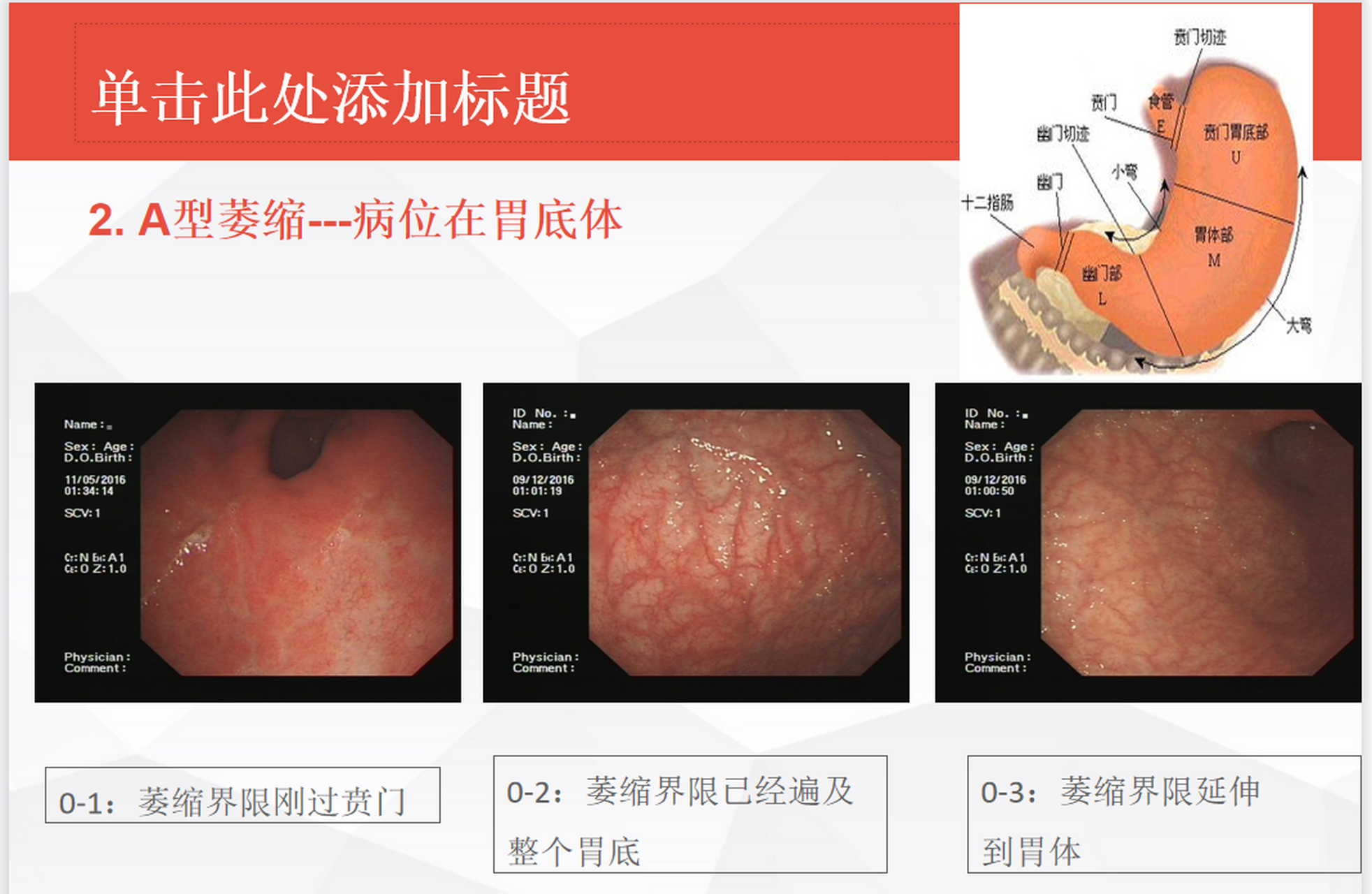 萎缩性胃炎# #慢性萎缩性胃炎# #脾胃专家王碧辉主任#   a型胃炎和 