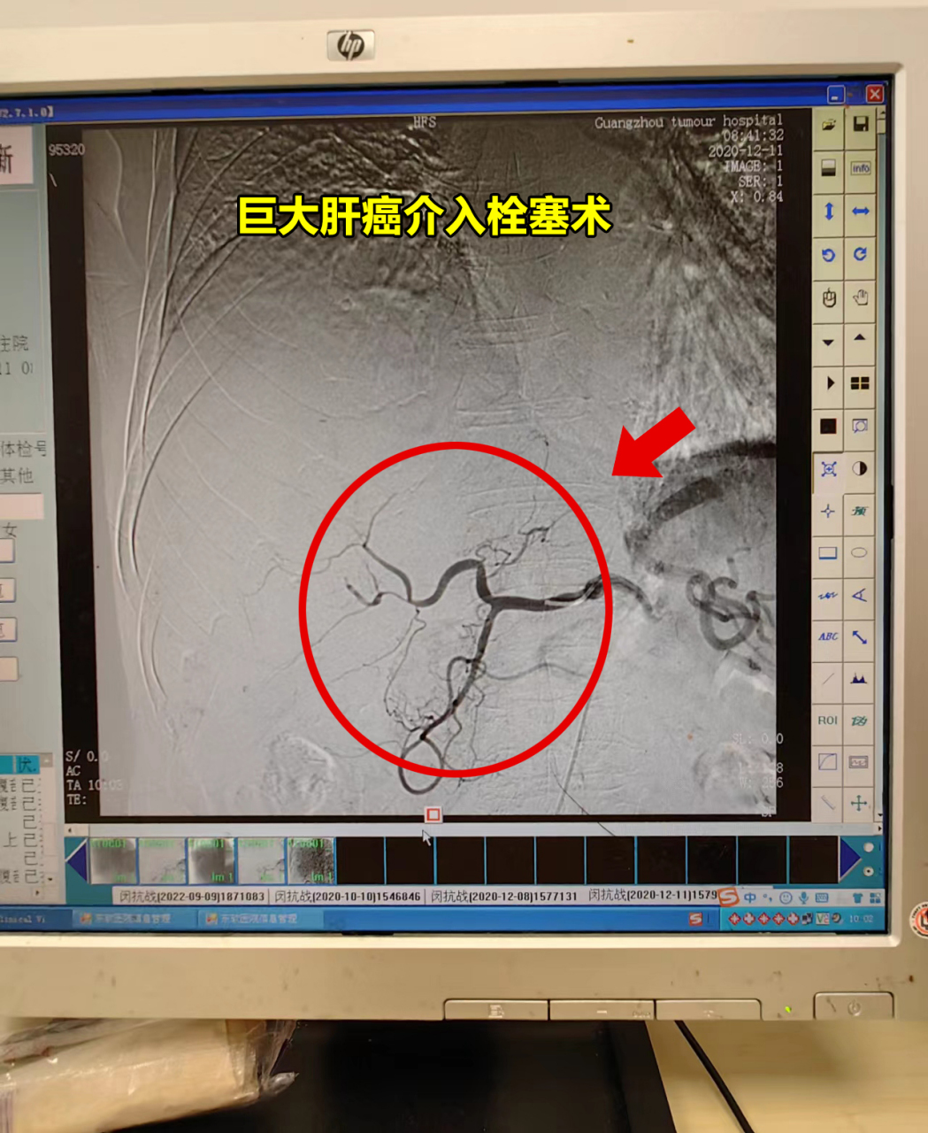 3):右叶巨大肝癌,直径达25cm,因患者年龄太大,不适合手术治疗,采用