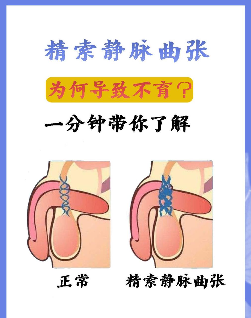 精索静脉曲张为什么会不育,一分钟带你了解!