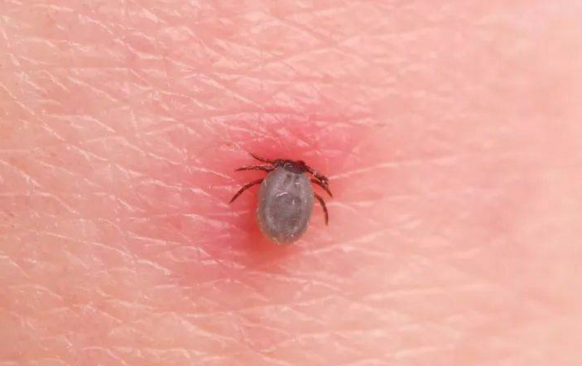 近期网上都在报道讨论"老太被蜱虫叮咬去世 四名亲属感染",七旬老太被