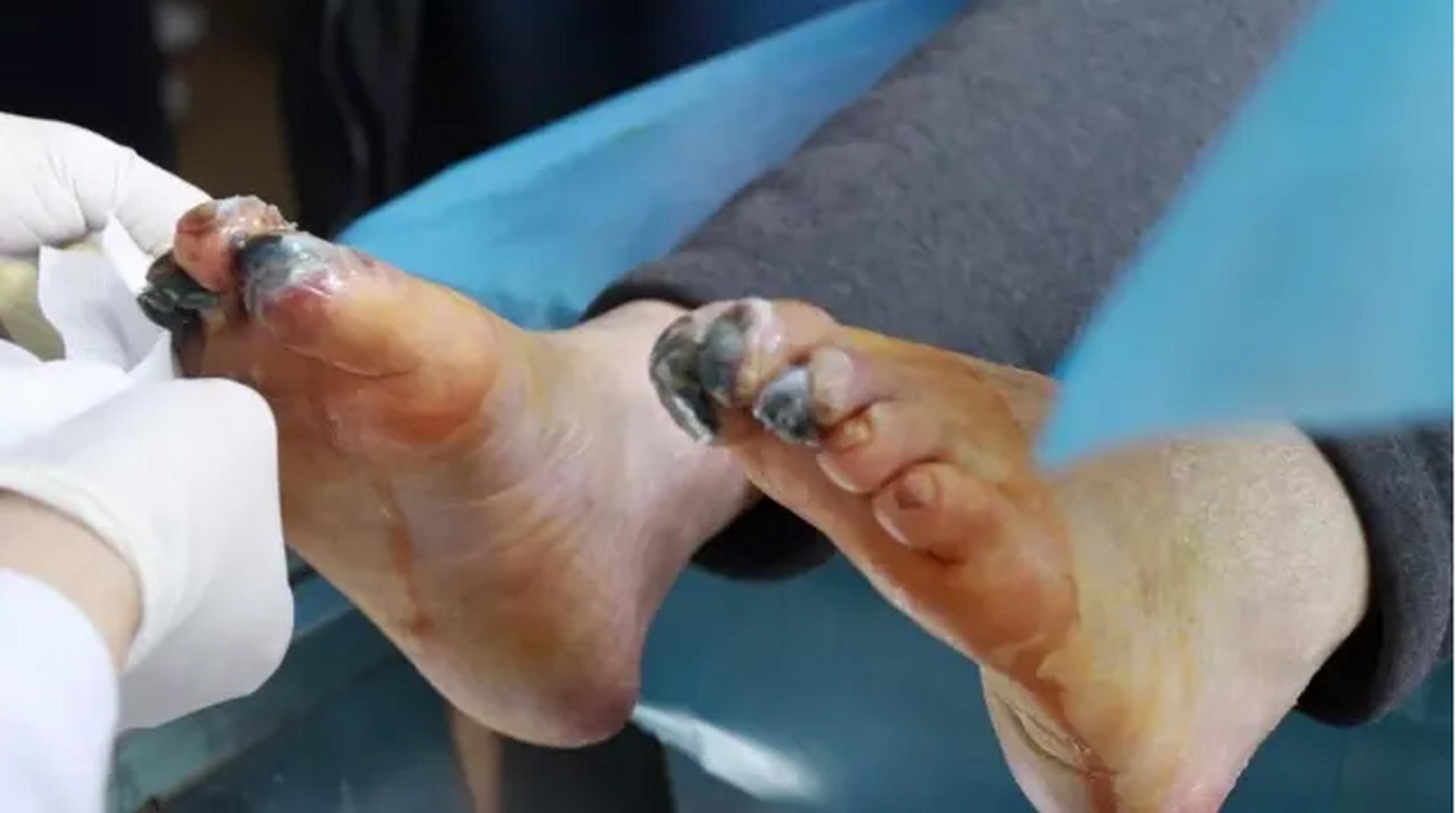 血栓闭塞性脉管炎不是很常见,但是在青少年中患病率在不断上升,目前