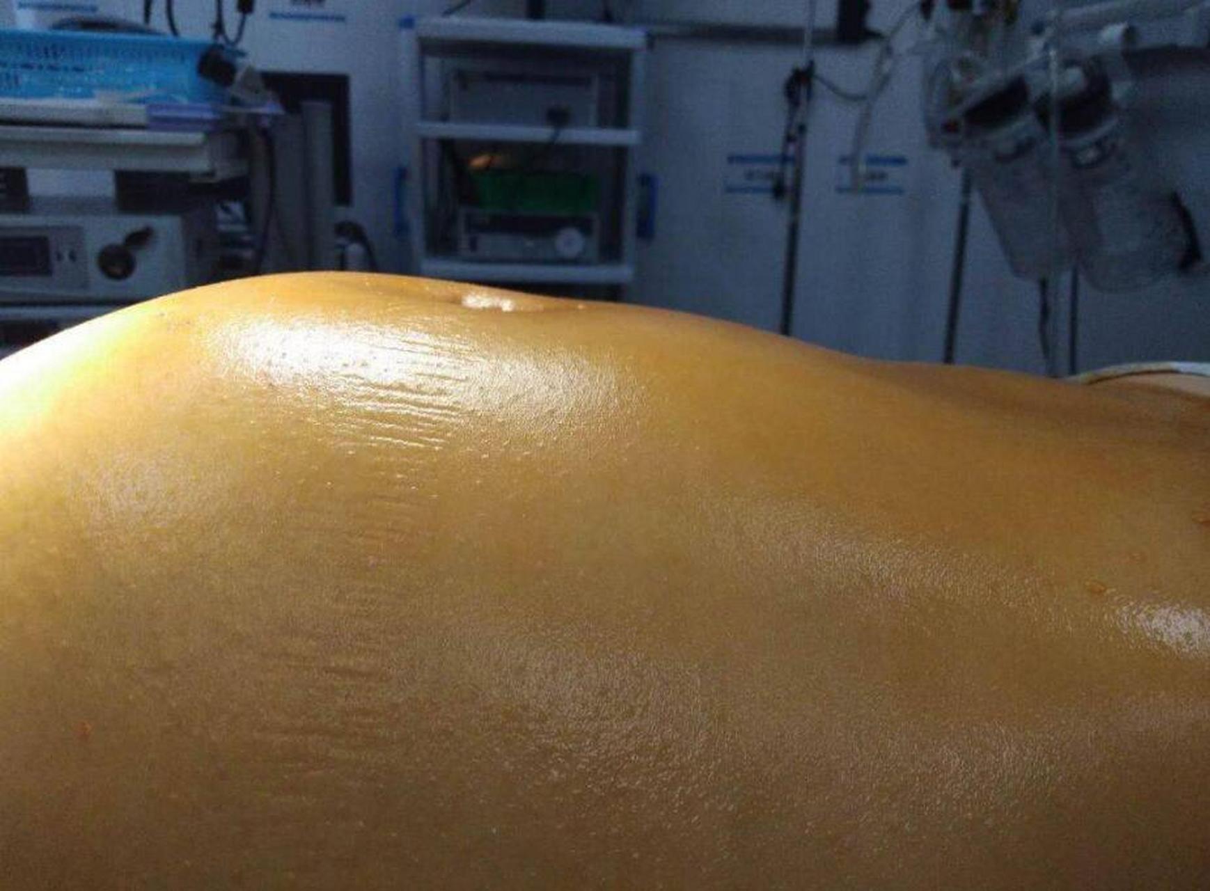 肝硬化腹水痛苦吗?