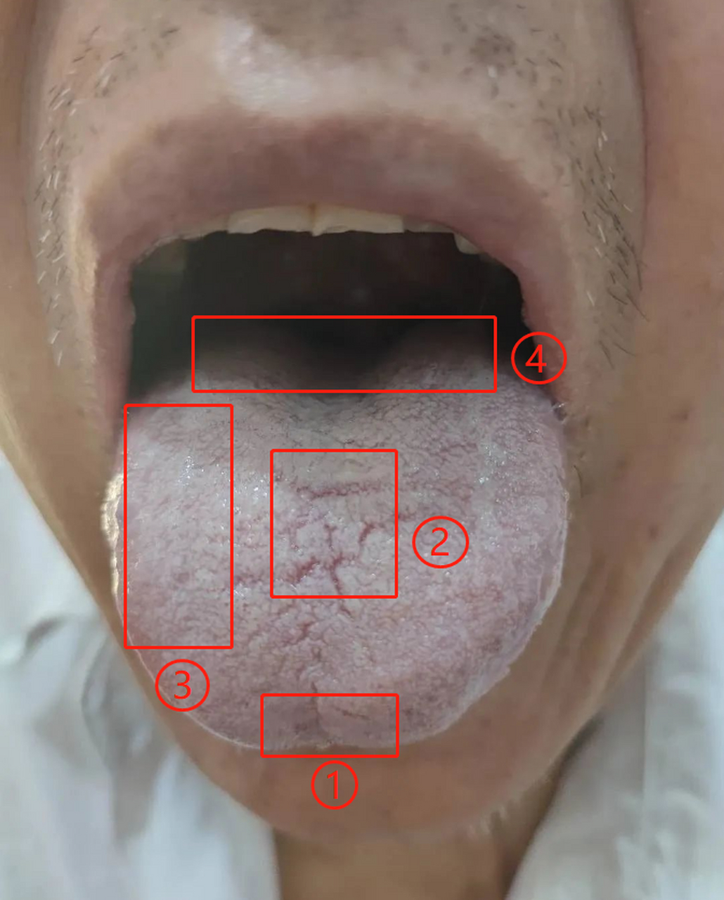 一般多见甲状腺的问题,或者一些鼻炎也多见舌前中间的裂纹 标记2,此