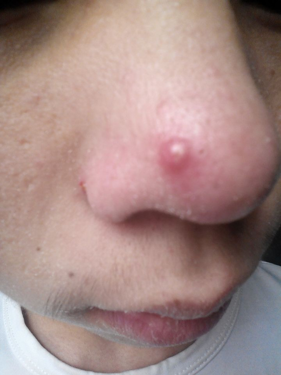 深度清洁皮肤,但不要过度清洁 容易生痘痘的朋友,每天都需要彻底