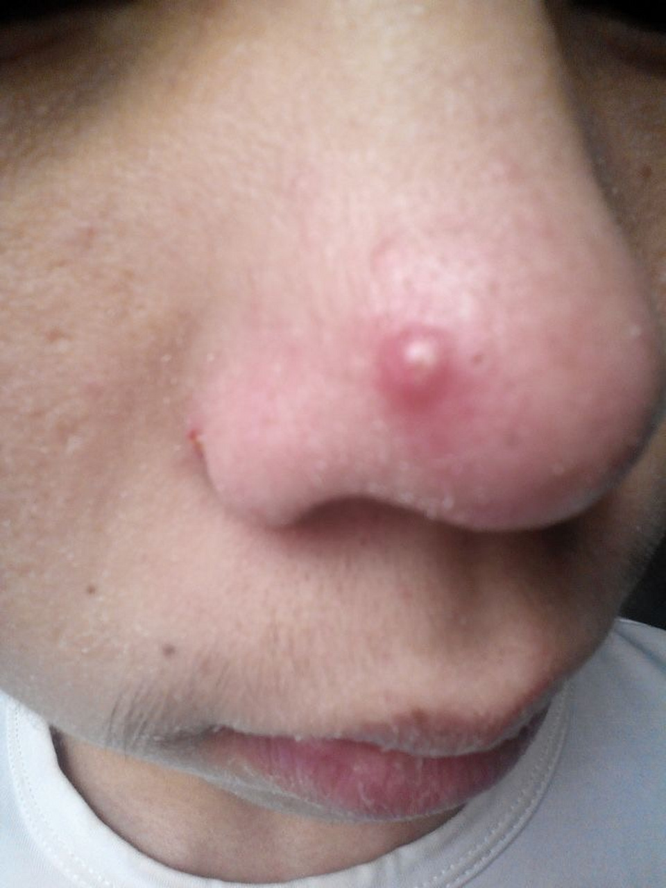 下面是一些常见的原因:  1,过度油脂分泌:鼻子周围的皮脂腺较为集中