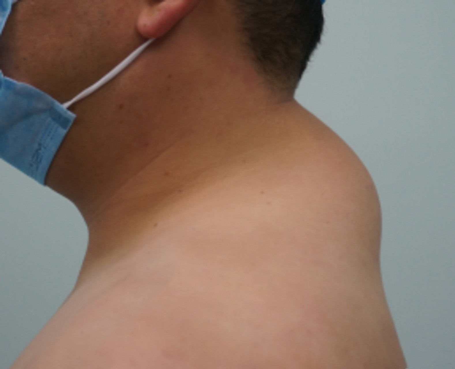 富贵包是一种良性脂肪堆积,通常是由于不健康的