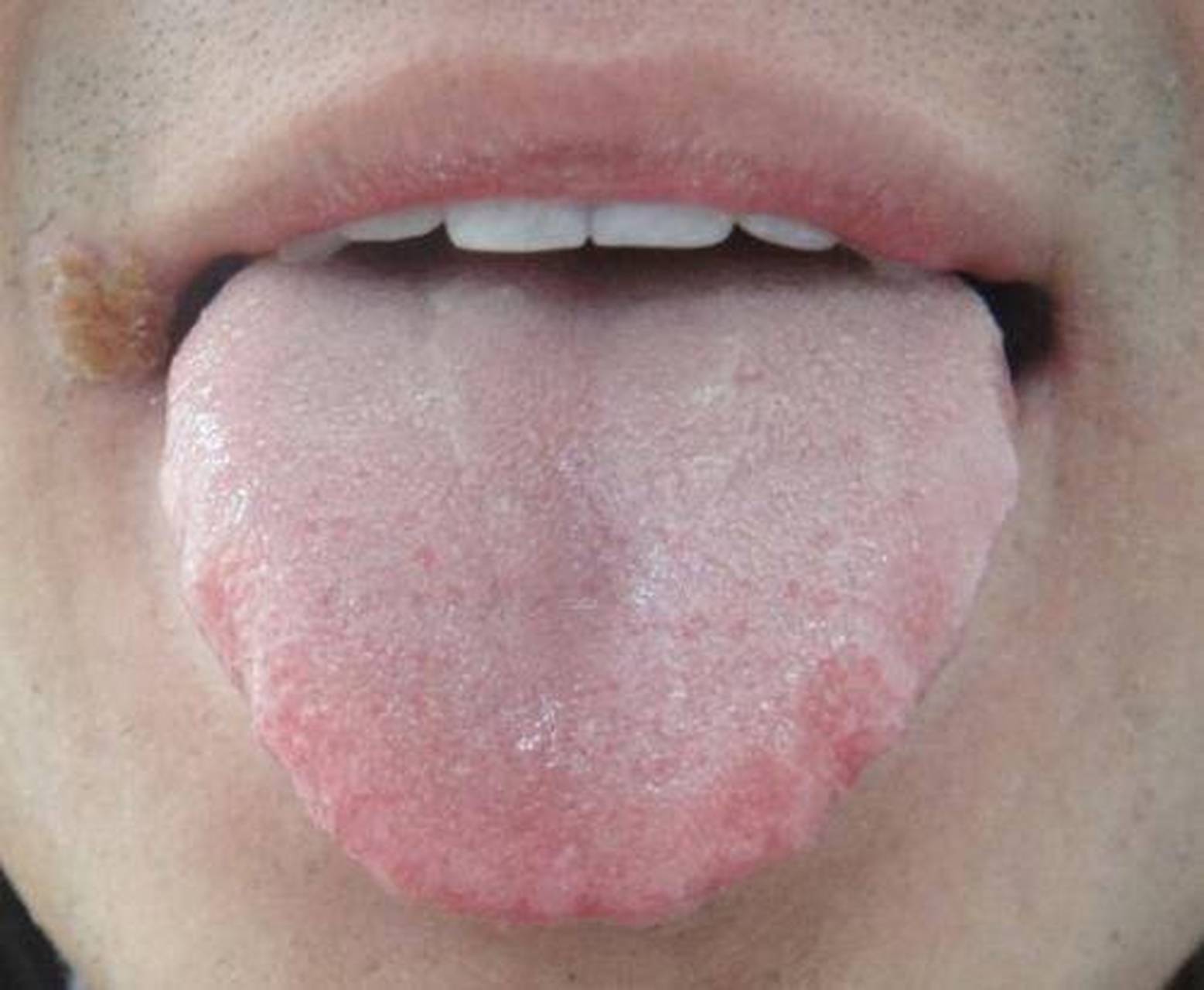 就是胖大舌,舌体较正常的舌体的更胖大,伸舌满口,你看它的舌头伸出来