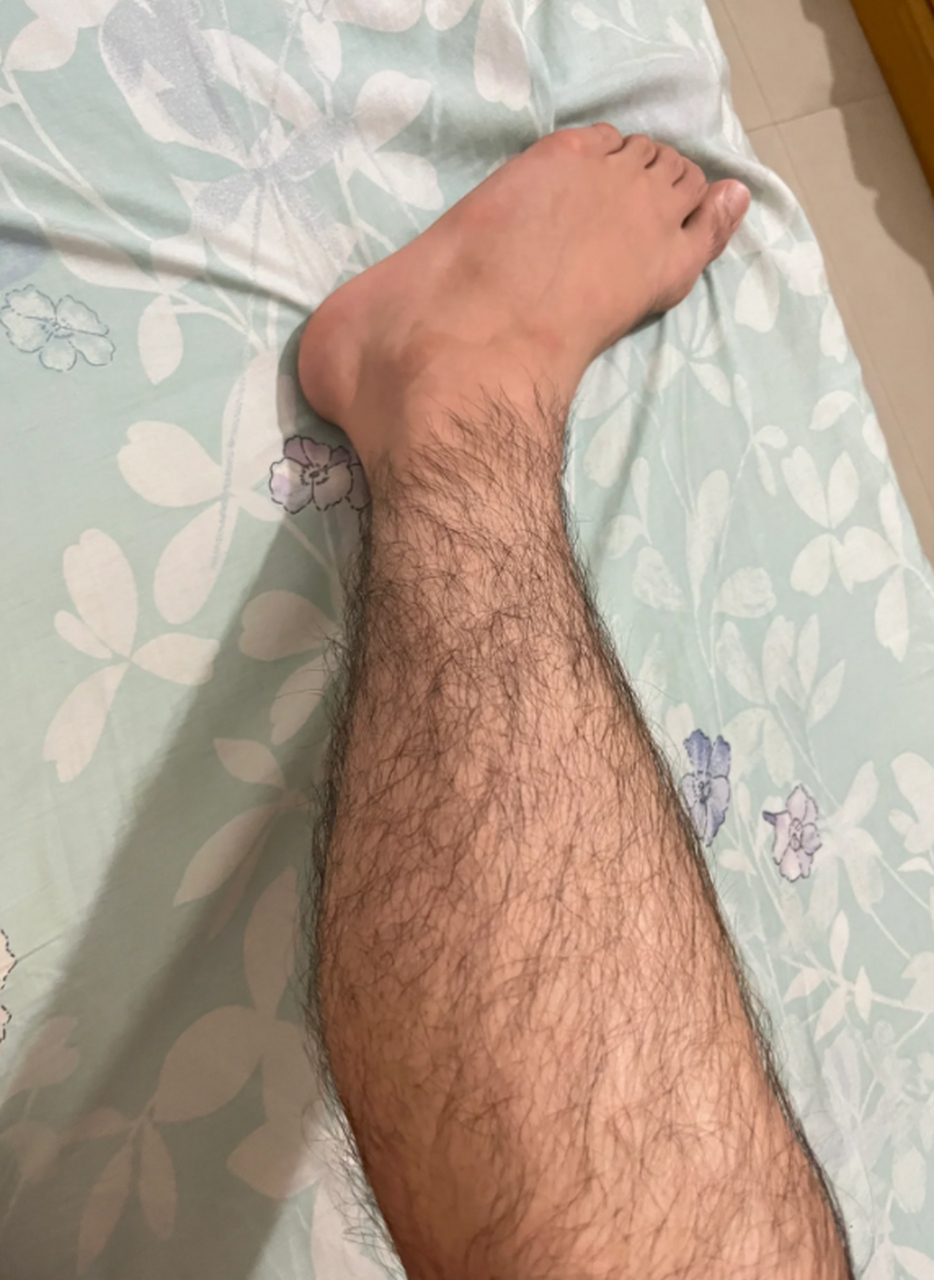 腿上汗毛怎么永久去除?