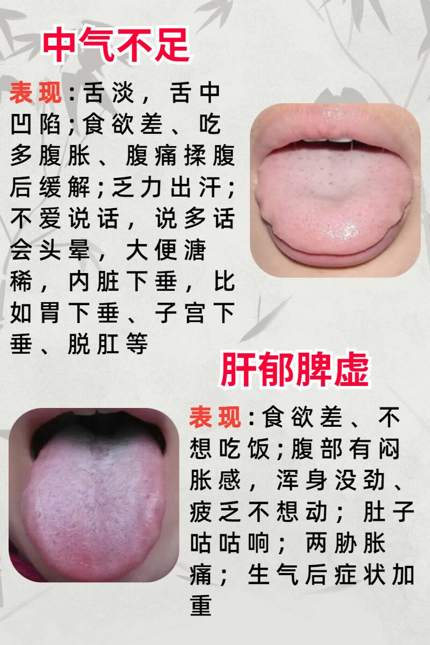 脾胃不好的6种征兆,对照你是哪一种?#脾胃# #脾胃虚弱# #胃病