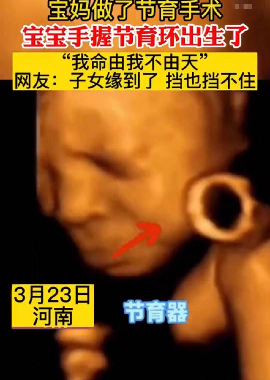 带环出生的婴儿图片图片