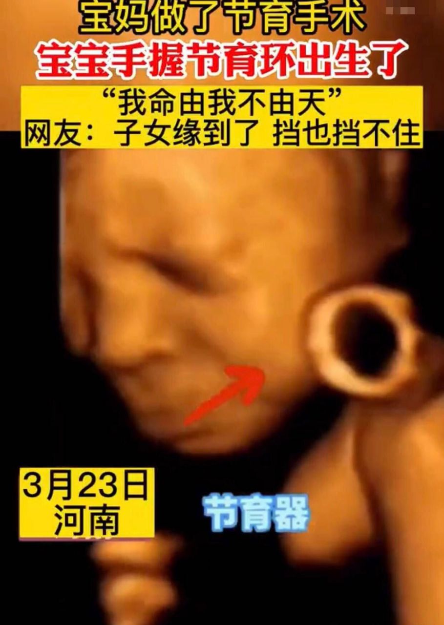 宝妈做了节育手术失败,宝宝手握节育环出生.