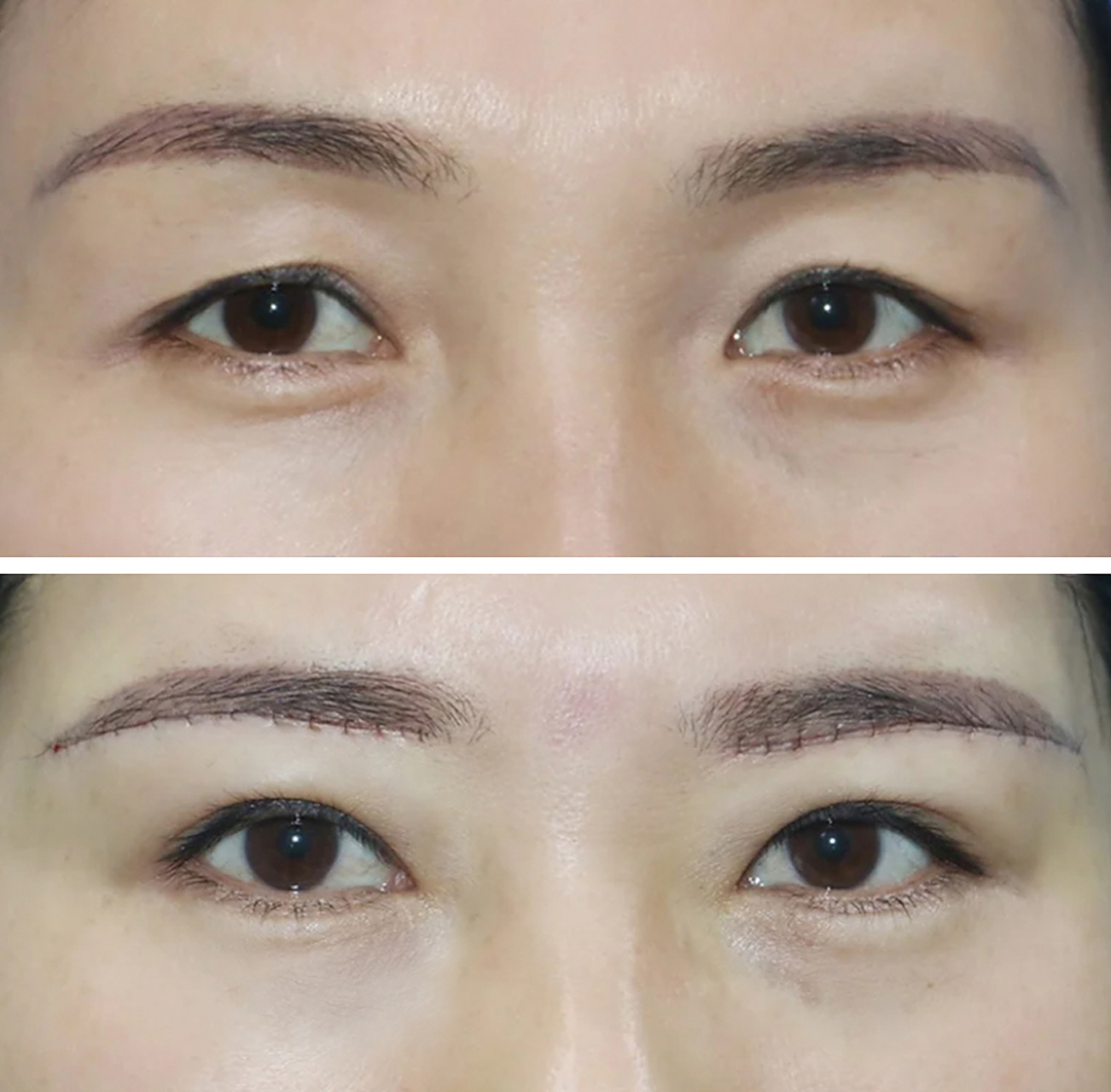 提眉手术后,切口恢复什么样,会留疤吗?